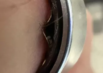 Аккумулятор Galaxy Ring раздувался прямо на пальце, умное кольцо пришлось снимать в больнице
